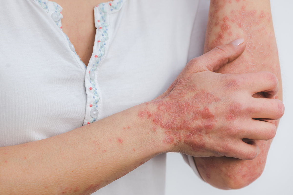 The 3 Best Vitamins & Supplements For Eczema Relief