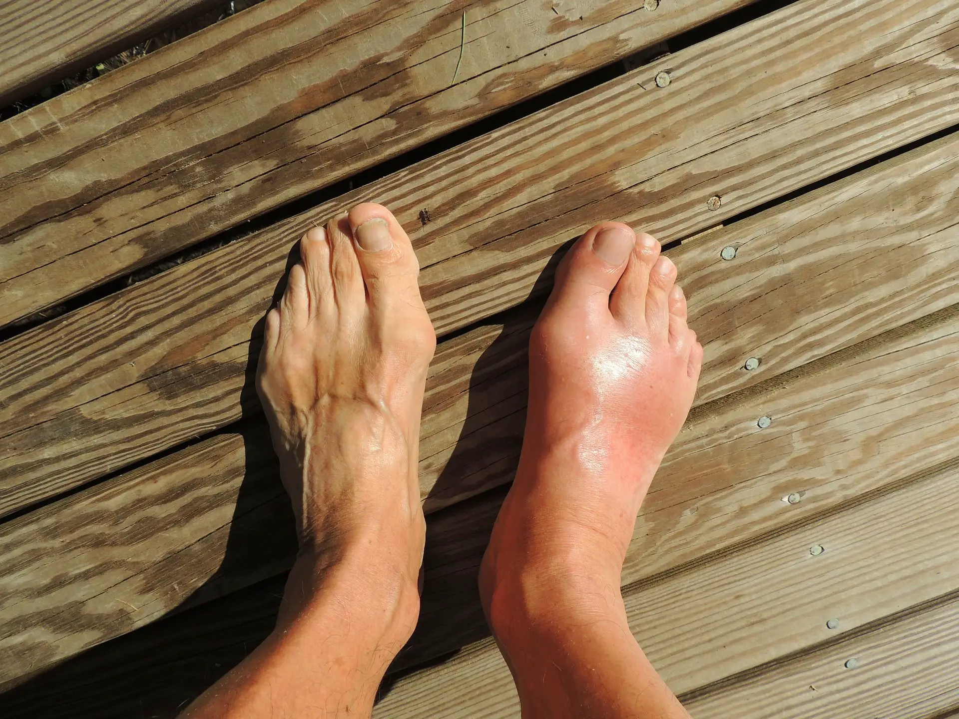 best vitamins for gout