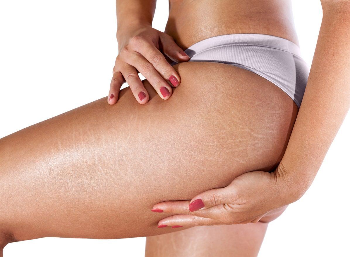 do stretch marks go away?